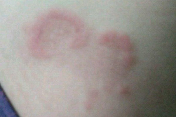 太原看体股癣，股癣怎么引起的