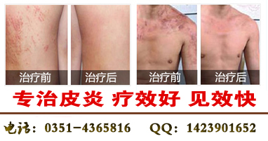 太原皮炎医院地址，我这是口周皮炎吗