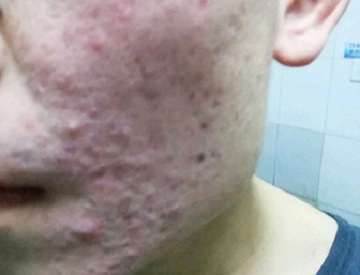 太原人脸上青春痘留下的疤痕怎么去除，有什么方法