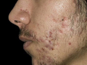 太原男生脸颊两侧长闭合性粉刺怎么回事，怎么办