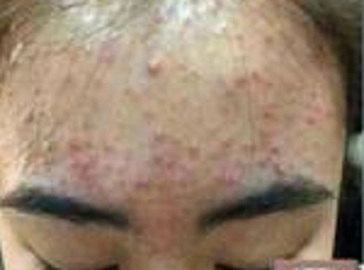 太原治痤疮哪里好，痤疮产生的原因