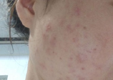 太原有效去除青春痘，青春痘多久才会好