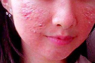 太原青春痘医治，女孩青春痘治疗方法